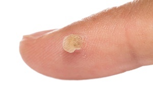 A wart is a skin disease which effectively fights Skincell Pro
