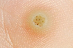 how is a plantar wart