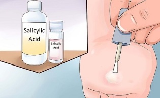how to get rid of papillomas using popular methods