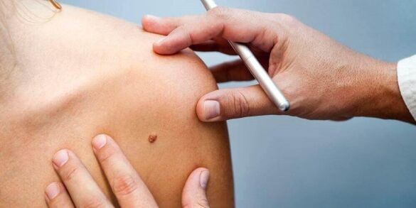 Examination of the patient by a dermatologist before removing the papilloma