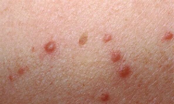 The appearance of papillomas on a woman's skin