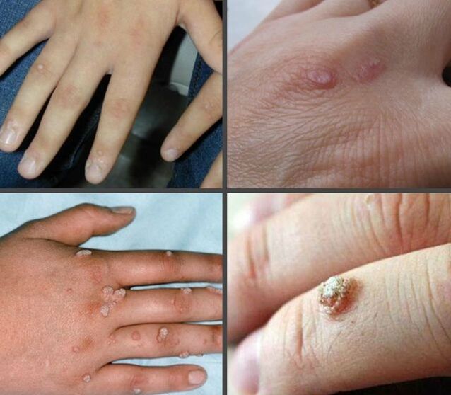 The appearance and location of warts on hands